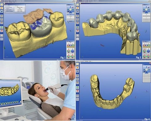 Scannerizzazione 3D arcata dentale